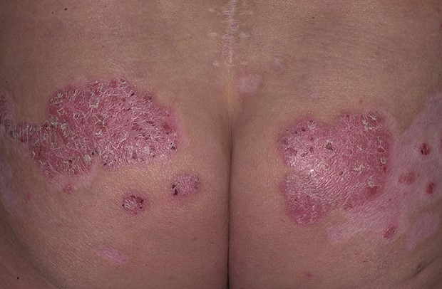 psoriasis-buttocks
