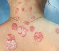psoriasis-definition-2