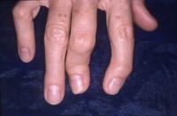 psoriasis-definition-3