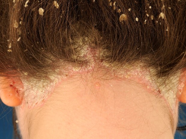 psoriasis-hair