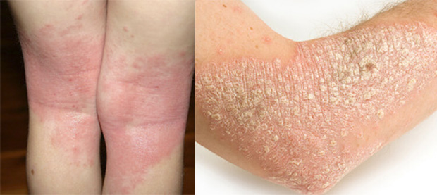 psoriasis-knee