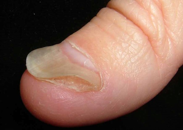 psoriasis-nails-symptoms-2