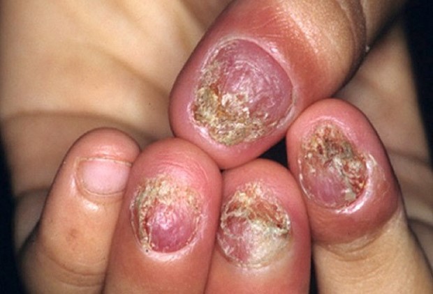 psoriasis-nails-symptoms-3