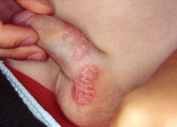 psoriasis-penis