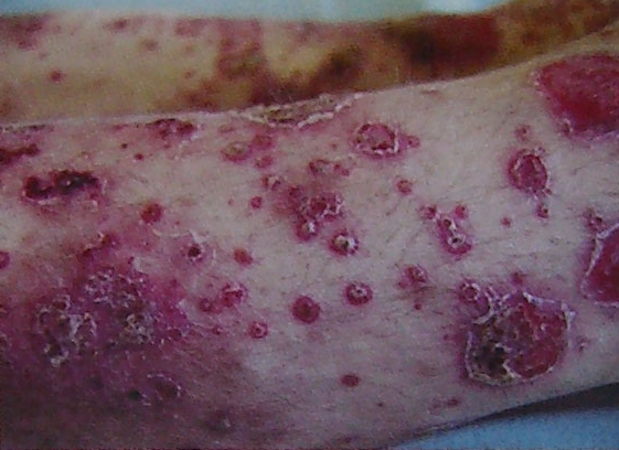 psoriasis-pustular-cumbush