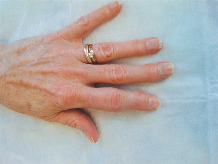 psoriasis-start-arthritis-4
